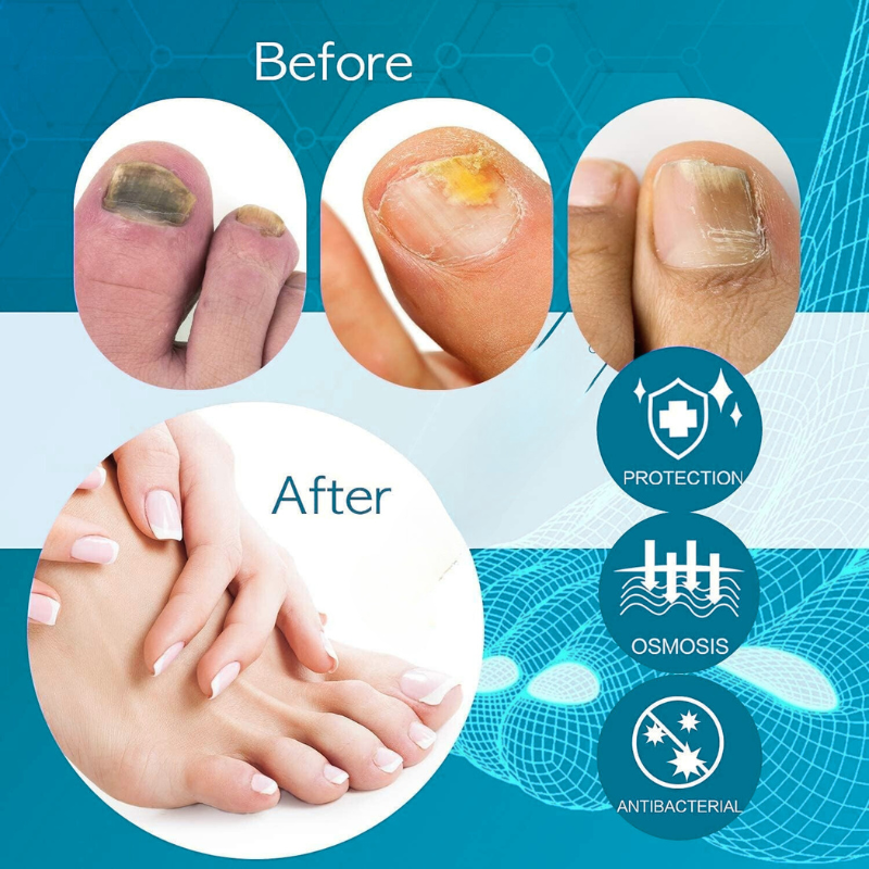 GermOut™ – Anti-Fungal & Anti-Odor Spray | Prevents Nail & Foot Infections